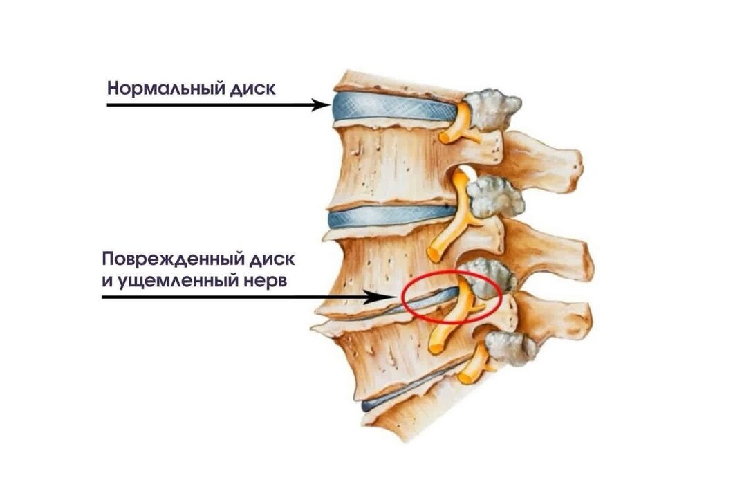 Symptômes de l'ostéochondose cervicale