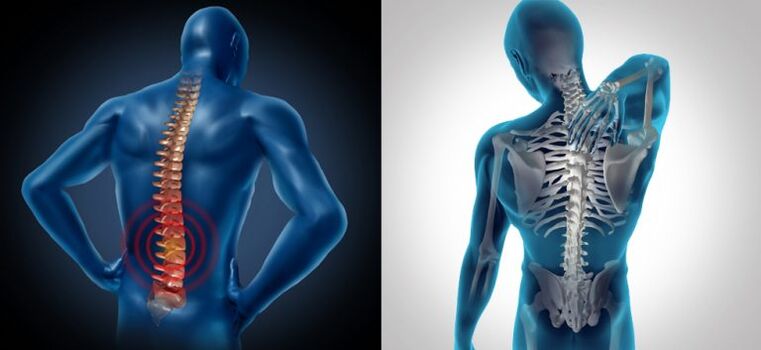 Inflammation dans l'ostéochondrose vertébrale