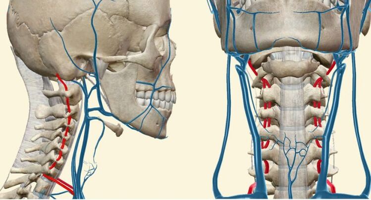 Syndrome vasculaire dans l'ostéochondrose
