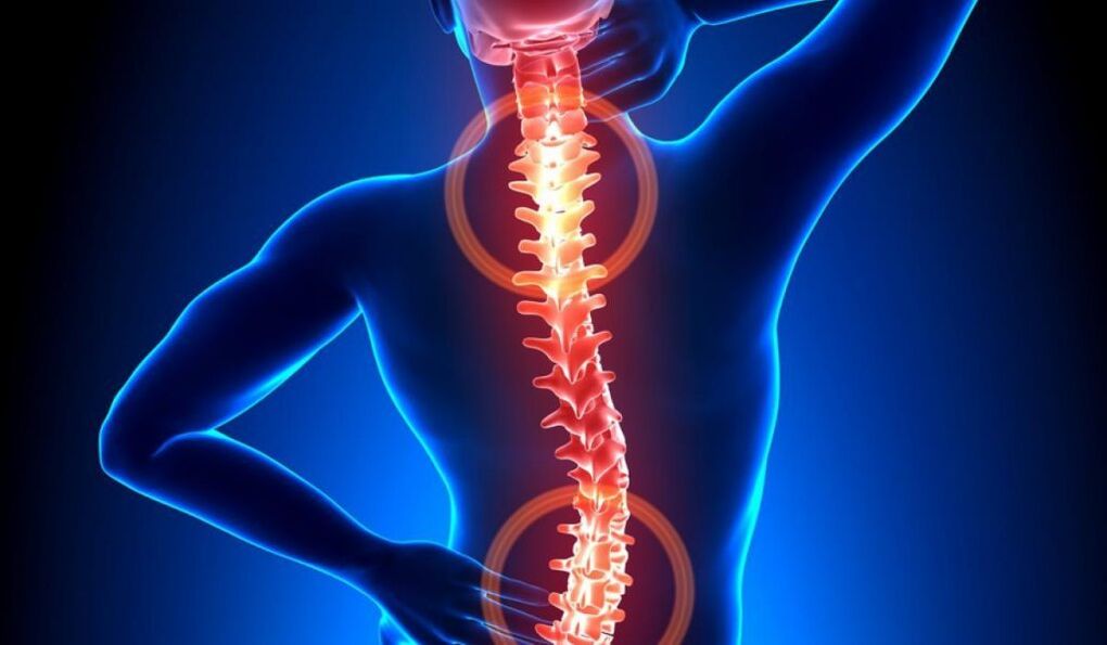 ostéochondrose vertébrale