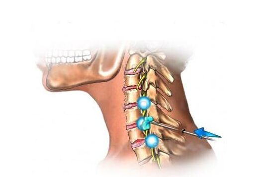 traitement de l'ostéochondrose cervicale
